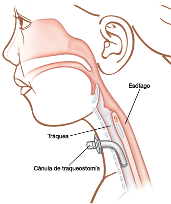 traqueostomia